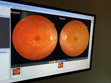 A photo of the left and right retina of a patient, side by side in one screen. The image is used to analyze for any retinopathy